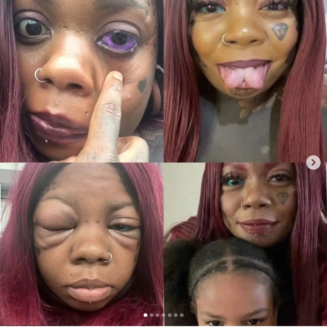 Mother Going Blind After Tattooing Eyeballs Blue And Purple To Copy Influencer Tmy Newspaper